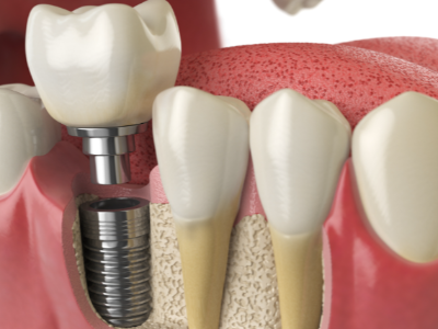 選擇種植牙后要做哪些日常維護(hù)？