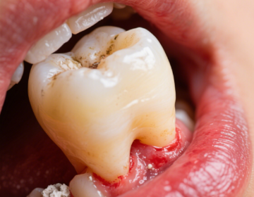 牙齒松動(dòng)最佳補(bǔ)救方法