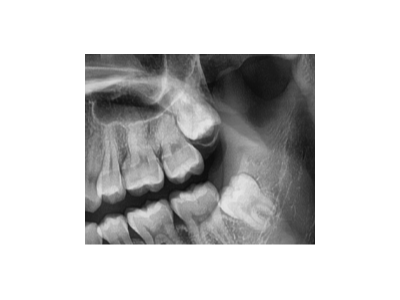 既然「智齒」不宜久留，為什么不能一次性拔掉？